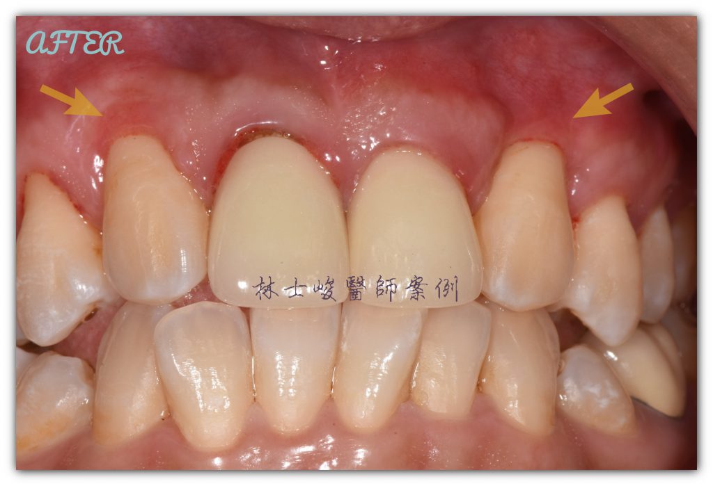 林士峻醫師-牙根覆蓋術-After1