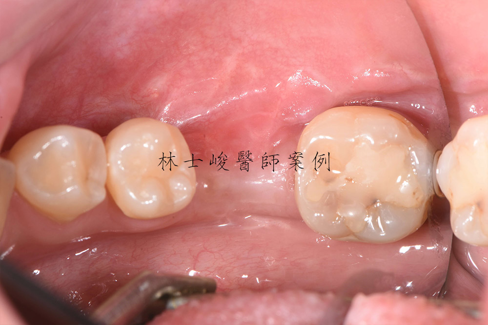 台北牙醫-植牙推薦-補骨-補牙