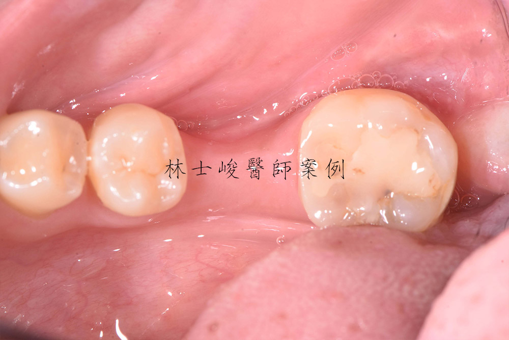 2-台北牙醫-植牙推薦-補骨-補牙肉-牙周病