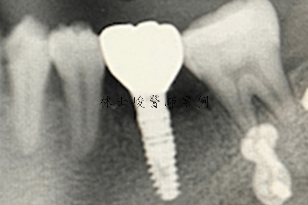 台北牙醫-植牙推薦-補骨-補牙肉-牙周病
