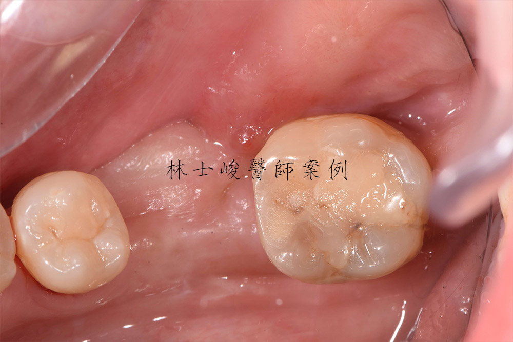 台北牙醫-植牙推薦-補骨-補牙