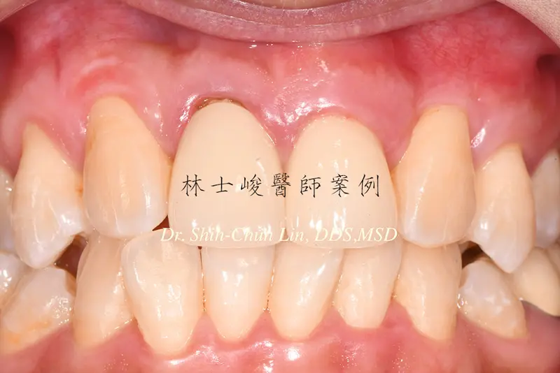 牙根覆蓋術-治療後