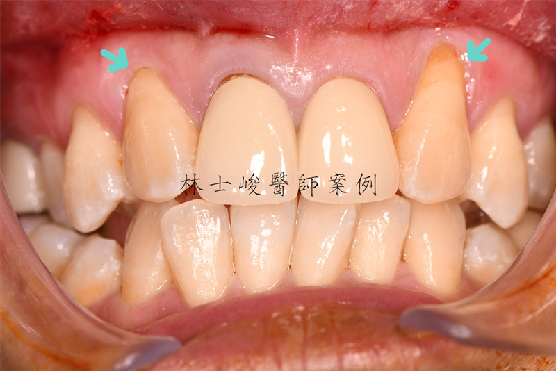 牙根覆蓋術-治療前