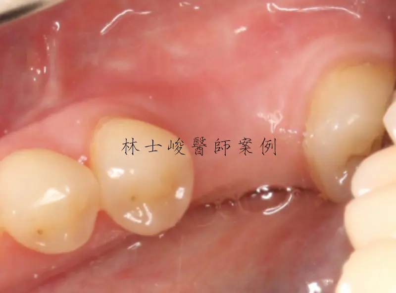 牙齦萎縮(牙周再生術) 1 牙根再生術01 1