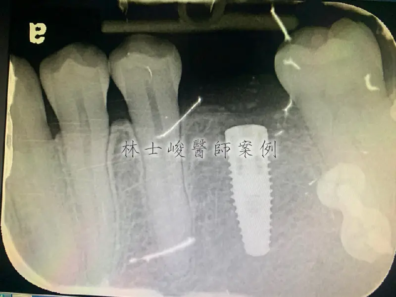 牙齦萎縮(牙周再生術) 2 牙根再生術02 1jpg
