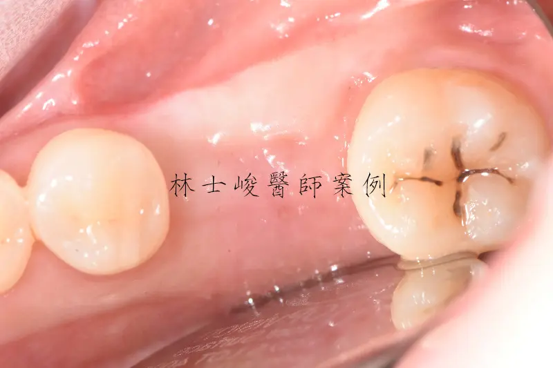 牙齦萎縮(牙周再生術) 3 牙根再生術03 1