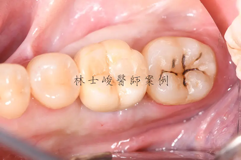 牙齦萎縮(牙周再生術) 4 牙根再生術04 1 2