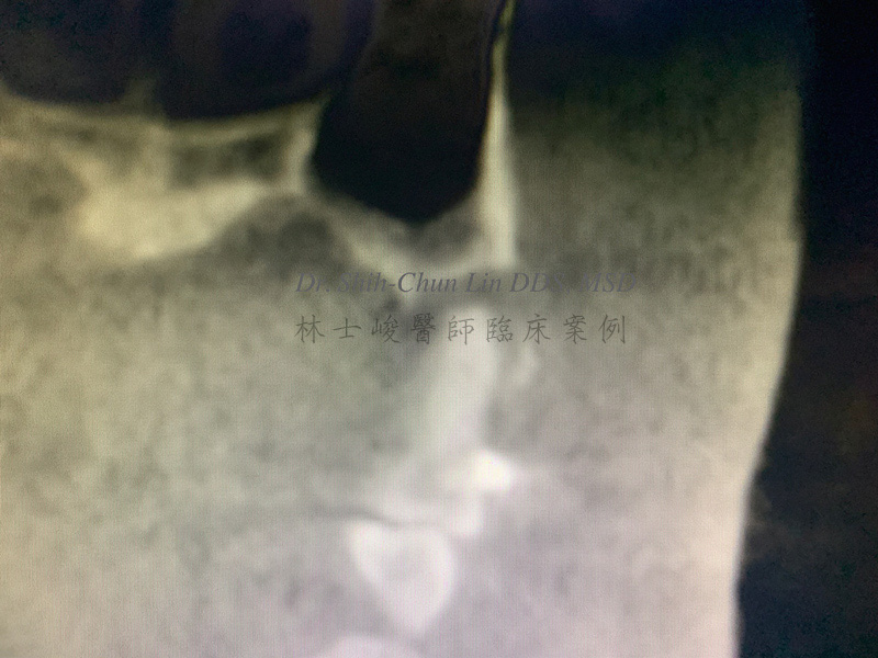 2（頰側面）可看到第二小臼齒牙根周圍齒槽骨嚴重流失 牙根與鼻竇腔只有一層薄薄的骨頭相隔 林士峻醫師個案01