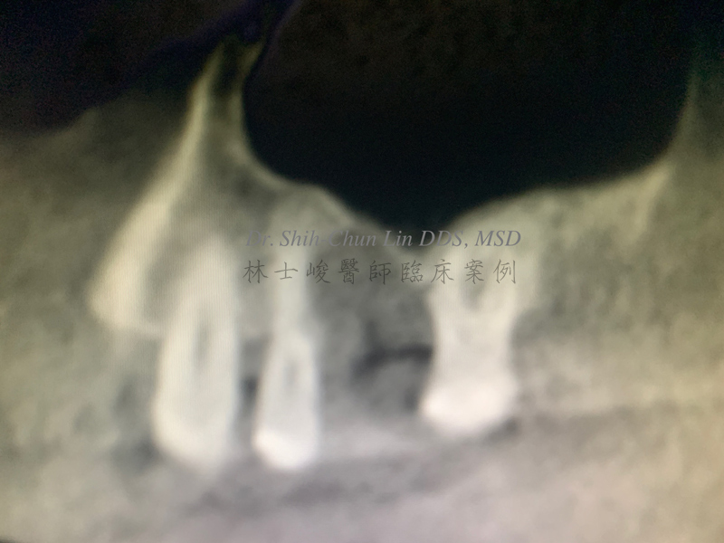 3.（冠狀面）可看到牙根周圍完全沒有骨頭支撐 齒槽骨嚴重不足 林士峻醫師個案01