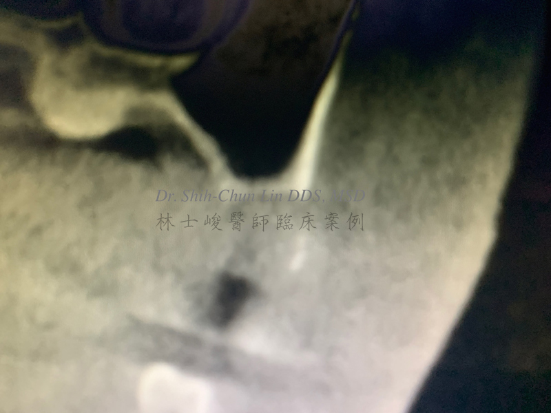 4.（頰側面）牙齒拔除後 只剩下鼻竇腔一層薄薄的骨頭 林士峻醫師個案01