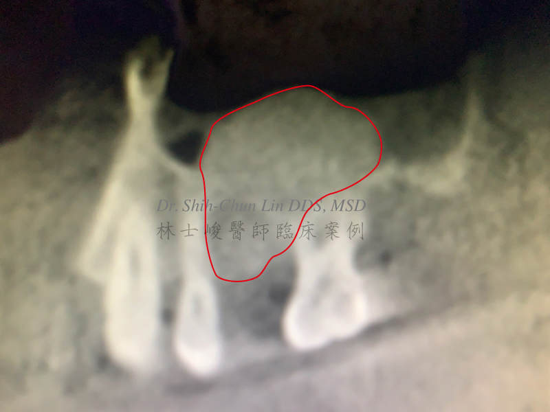 5. （冠狀面）拔牙後 鼻竇腔只剩一層薄薄的骨頭 不足以植牙 林士峻醫師個案01