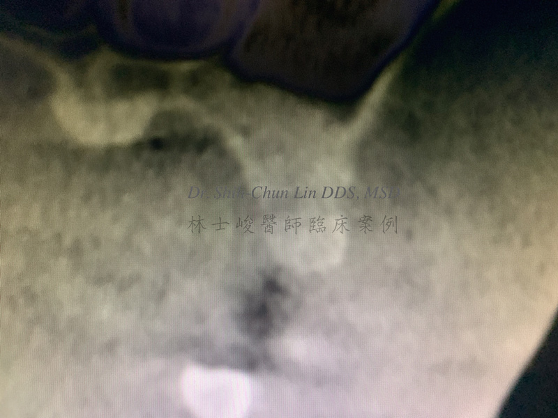 6. （頰側面）施予鼻竇增高數合併齒槽骨再生術 填上大量補骨再生材料 可以看到原本黑色的空腔區域都變成高骨密度的灰白色 表示骨量相當充足 林士峻醫師個案01