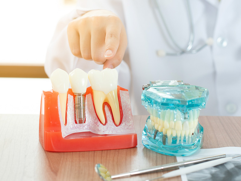 當植牙遇上牙周病怎麼辦？牙周病植牙需要注意的事