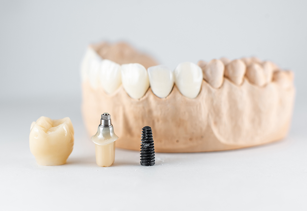 model of artificial jaw and dental implant PYXYEPD