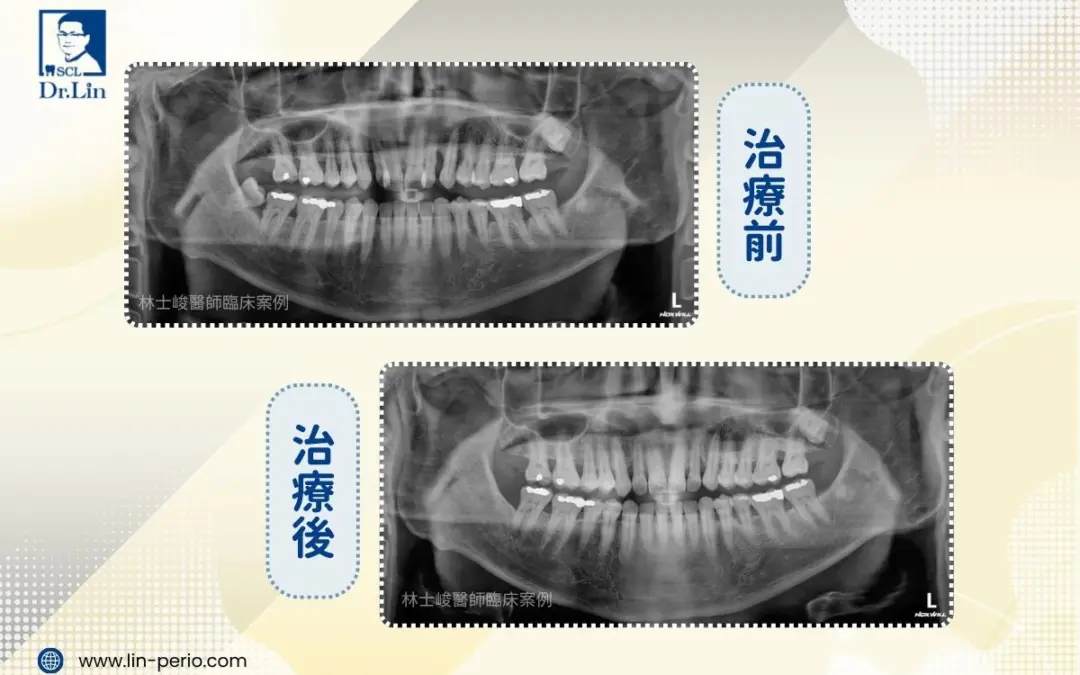 林士峻醫師｜重度牙周病治療後，也能穩定完成矯正嗎？