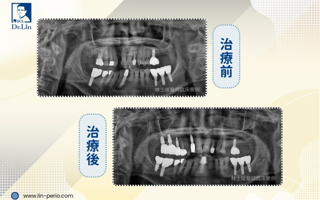林士峻醫師｜牙周病沒治好，缺牙只會更多：先穩住牙周，再植牙重建咬合