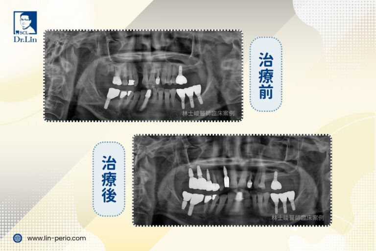林士峻醫師｜牙周病沒治好，缺牙只會更多：先穩住牙周，再植牙重建咬合